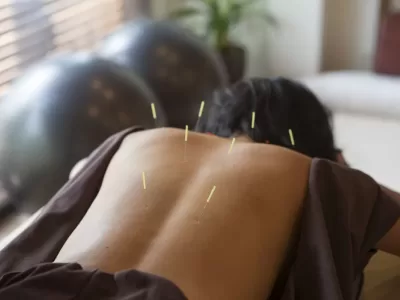 woman with acupuncture needles in her back